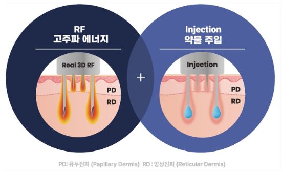 RF 고주파와 약물 주입